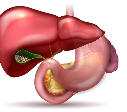 GALLSTONES AFTER BARIATRIC SURGERY