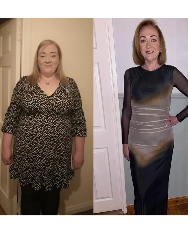 Before and after gastric bypass surgery