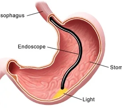 UPPER ENDOSCOPY