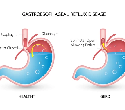 HEARTBURN / GERD (GASTRO ESOPHAGEAL REFLUX DISEASE)