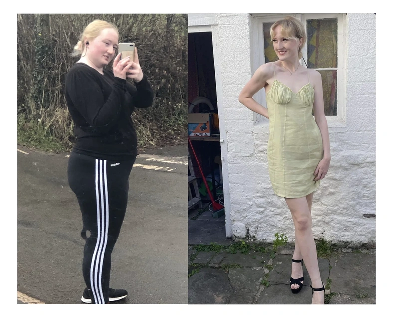 Before and after gastric sleeve surgery