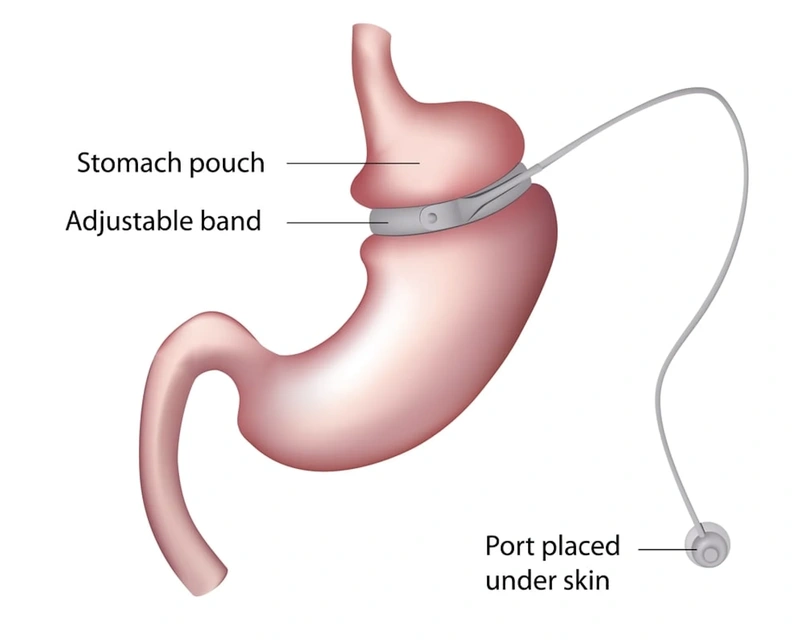 Gastric Band