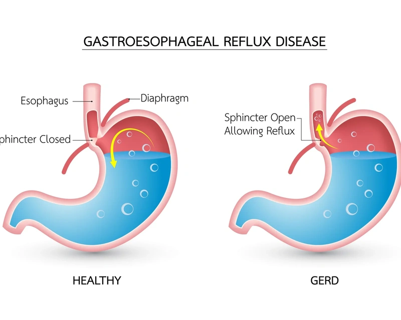 HEARTBURN / GERD (GASTRO ESOPHAGEAL REFLUX DISEASE)
