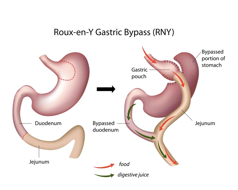 Gastric Bypass