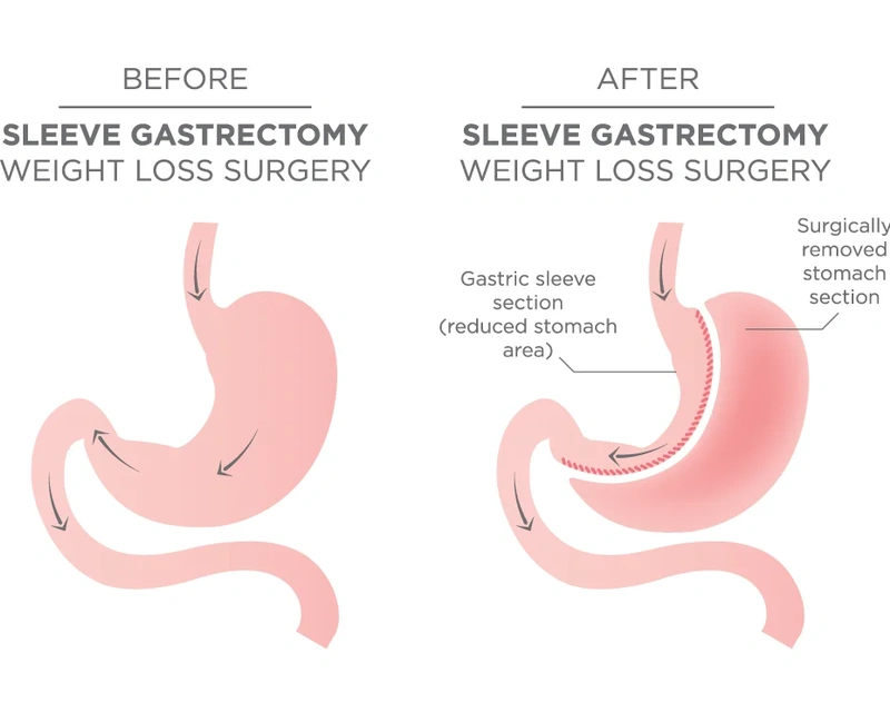 Sleeve gastrectomy surgery