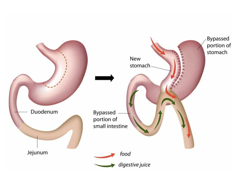 Mini Gastric Bypass