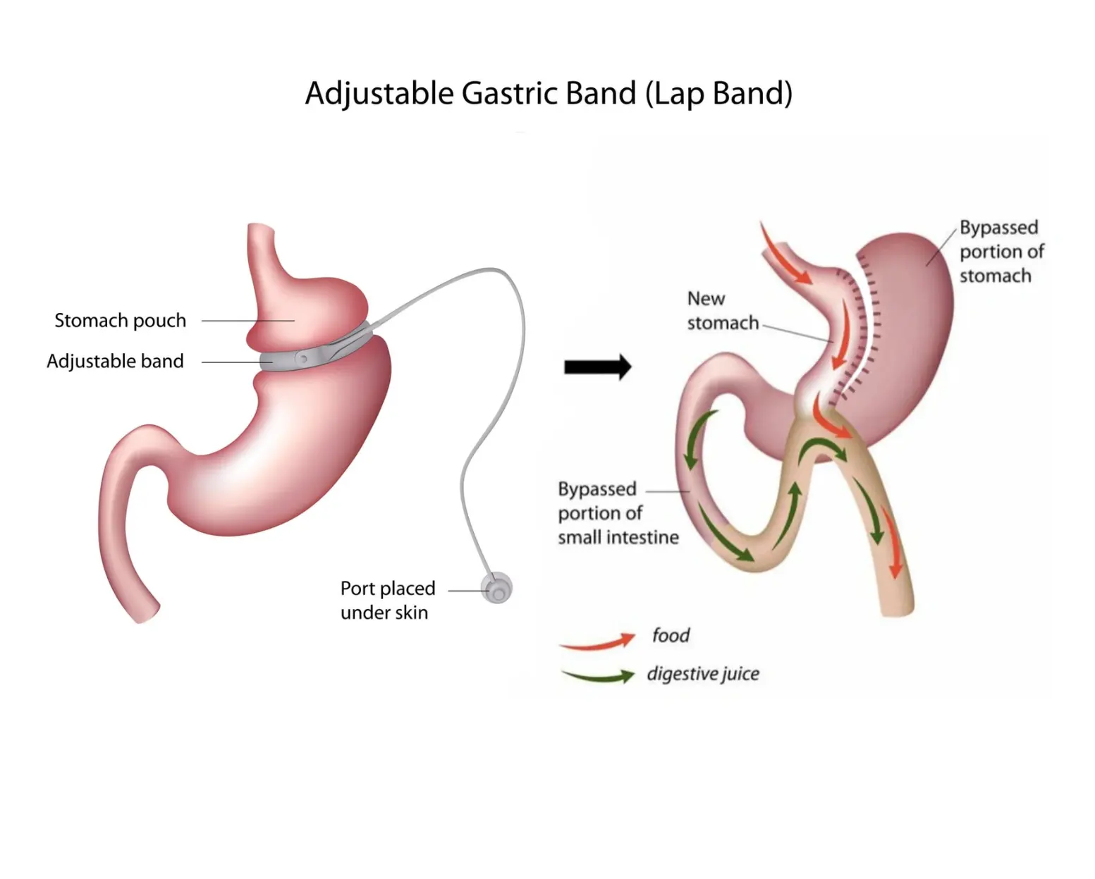 REVISION BARIATRIC SURGERIES