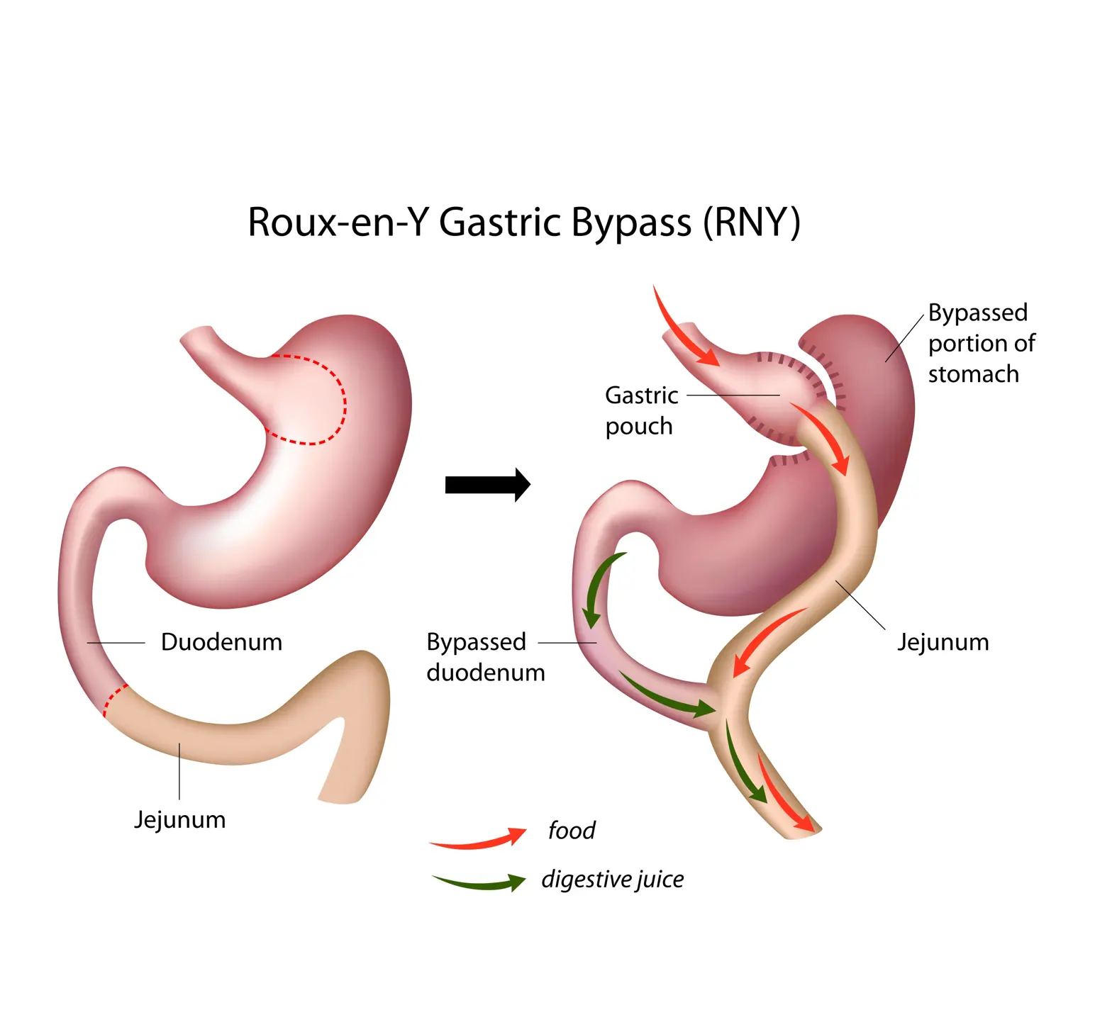 Gastric Bypass RNY